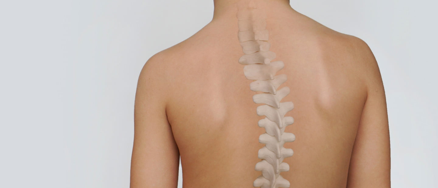 Scoliosis